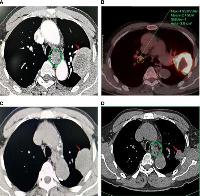 Case Report: Aumolertinib as Neoadjuvant Therapy for Patients With Unresectable Stage III Non-Small Cell Lung Cancer With Activated EGFR Mutation: Case Series